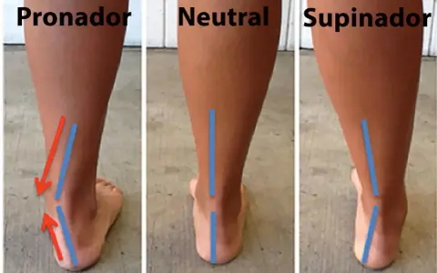 Vista posterior de tres tipos de pisada: pronador, neutral y supinador. El pronador muestra el tobillo inclinado hacia adentro.
